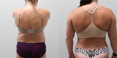 Liposuction before and after photo
