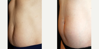 SculpSure before and after photo