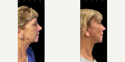 Facelift before and after photo