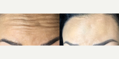 Botox before and after photo