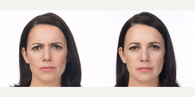Botox before and after photo