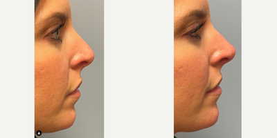 Chin Filler before and after photo
