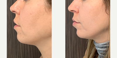 Dermal Fillers before and after photo