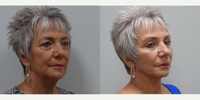Facelift before and after photo