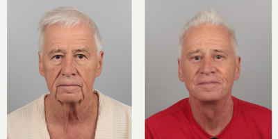 Facelift before and after photo