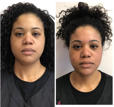 Microneedling before and after photo