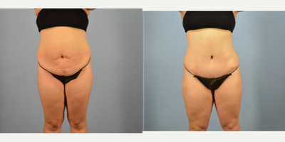 Tummy Tuck before and after photo