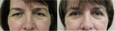 Eyelid Surgery before and after photo