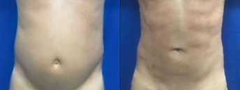 Vaser Liposuction before and after photo