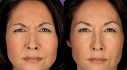 Botox before and after photo