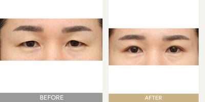 Brow Lift before and after photo