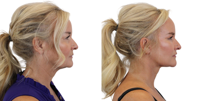 Facelift before and after photo