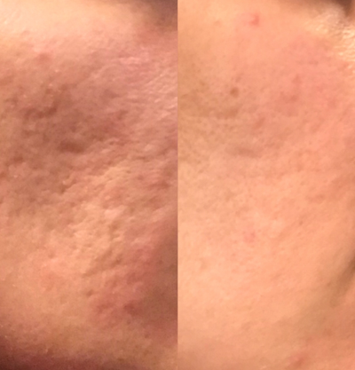 Microneedling before and after photo