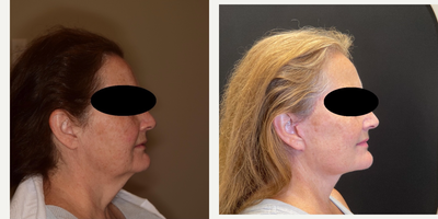 Deep Plane Facelift before and after photo
