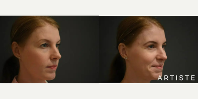 Eyelid Surgery before and after photo