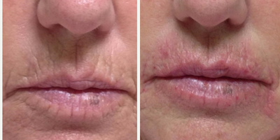 Juvederm before and after photo