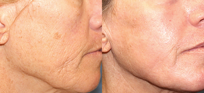 Skin Tightening before and after photo