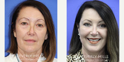 Facelift before and after photo