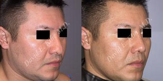 Revision Rhinoplasty before and after photo
