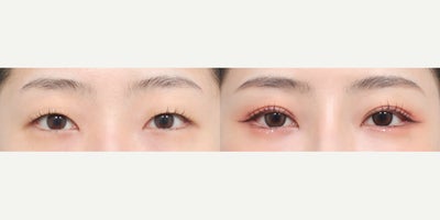 Double Eyelid Surgery before and after photo