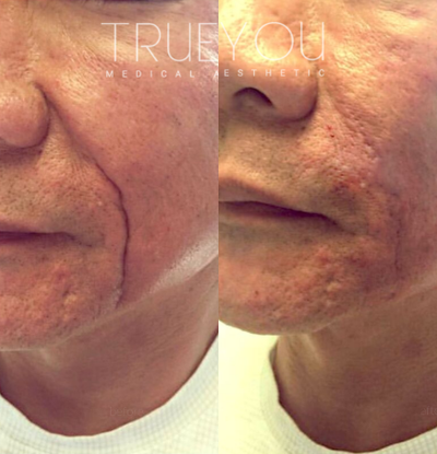 Juvederm before and after photo