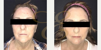 Laser Resurfacing before and after photo
