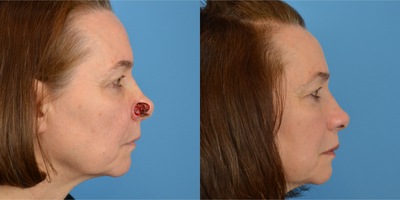 Mohs Surgery before and after photo