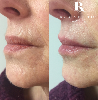 Restylane Silk before and after photo