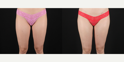 Breast Fat Transfer before and after photo