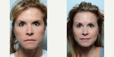 Brow Lift before and after photo