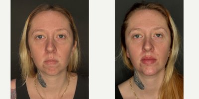 Chin Filler before and after photo