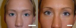 Double Eyelid Surgery before and after photo