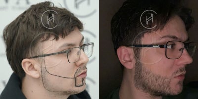 FUE Hair Transplant before and after photo