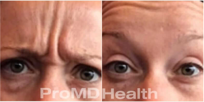 Dysport before and after photo