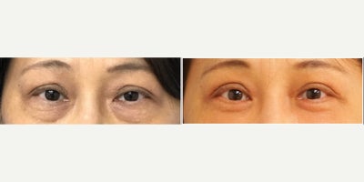 Eyelid Surgery before and after photo