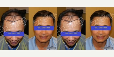 Hair Transplant before and after photo