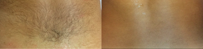 Laser Hair Removal before and after photo