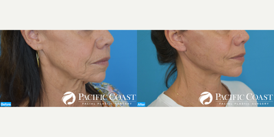 Neck Lift before and after photo