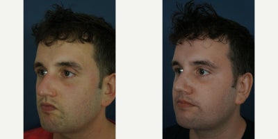 Rhinoplasty before and after photo