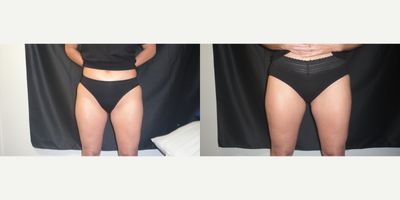 SculpSure before and after photo