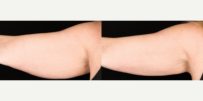 CoolMini before and after photo