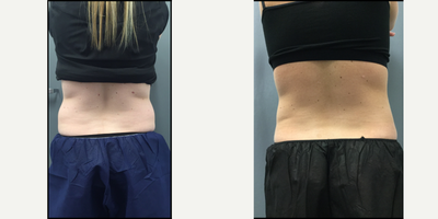 CoolSculpting before and after photo