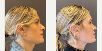 Eyelid Surgery before and after photo