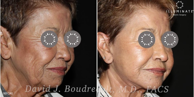 Facelift before and after photo