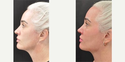 Facial Fat Transfer before and after photo