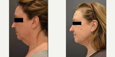 Liposuction before and after photo