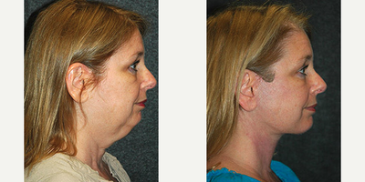Mini Facelift before and after photo