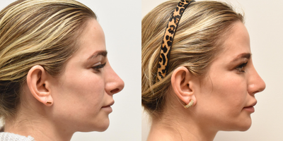 Revision Rhinoplasty before and after photo