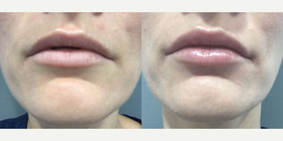 Volbella before and after photo