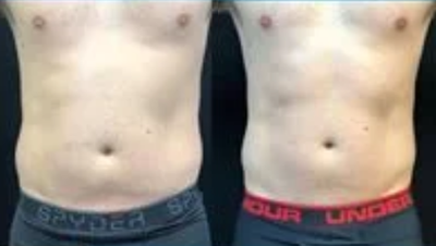 Emsculpt before and after photo